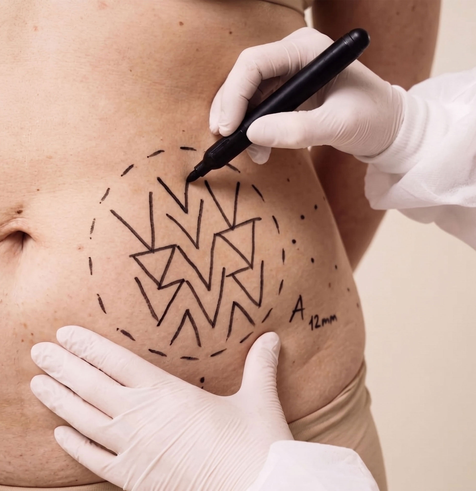 Tummy Tuck 1